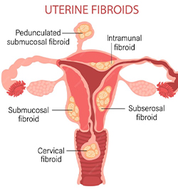 Uterine Fibroid