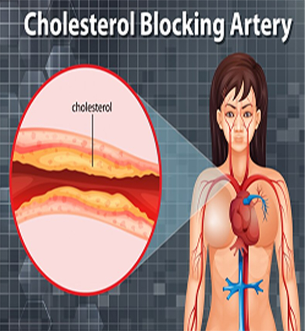 Cholesterol & Blood Fat