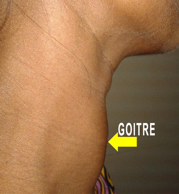 Goitre