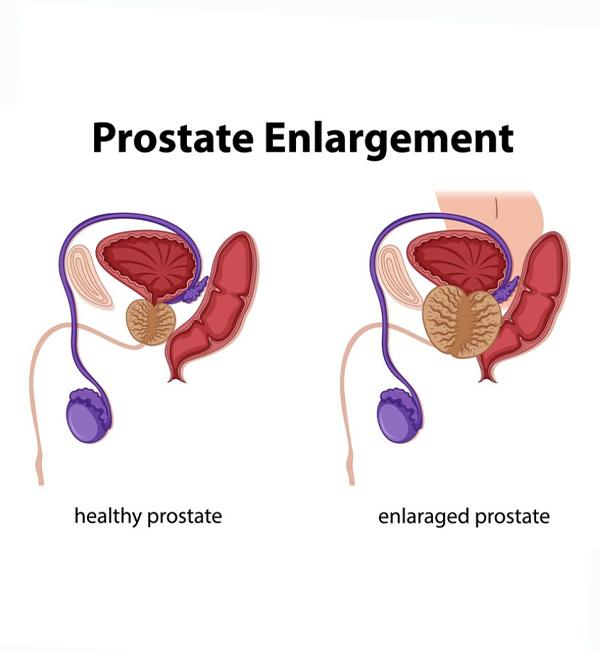Prostate Issues